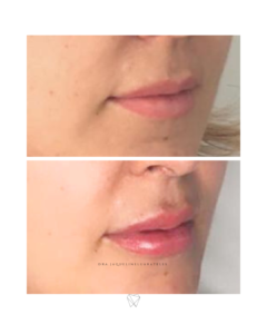 Preenchimento labial