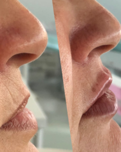 Preenchimento labial