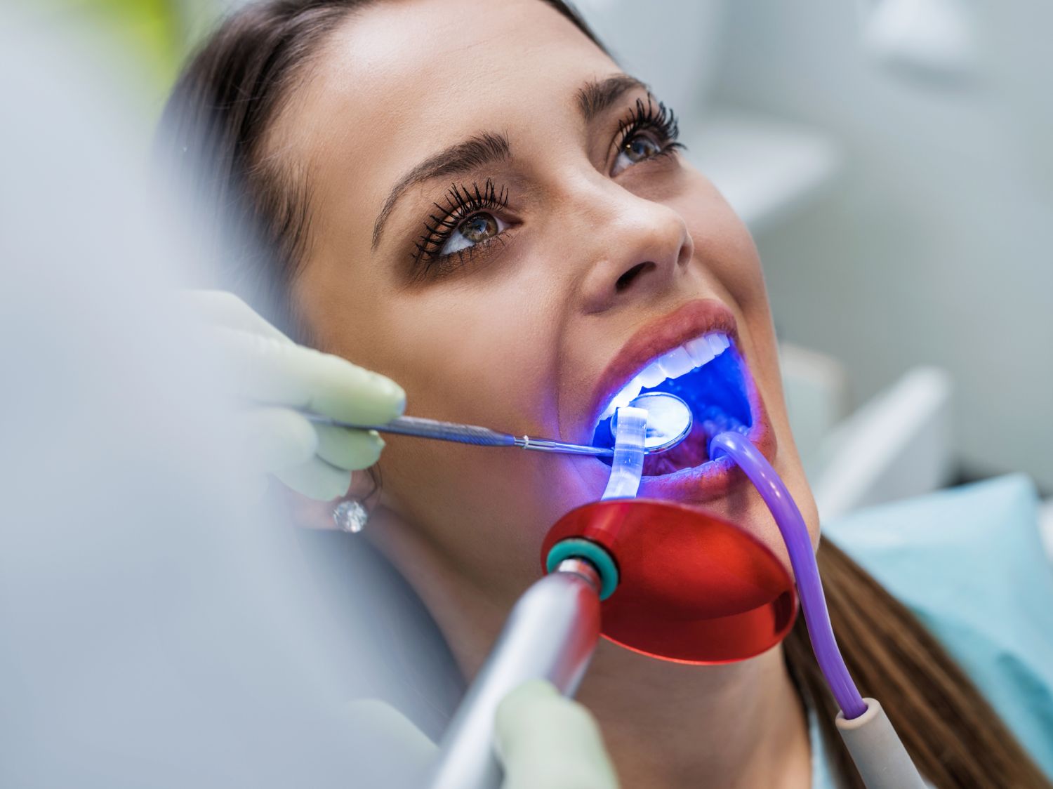 clareamento dental a laser