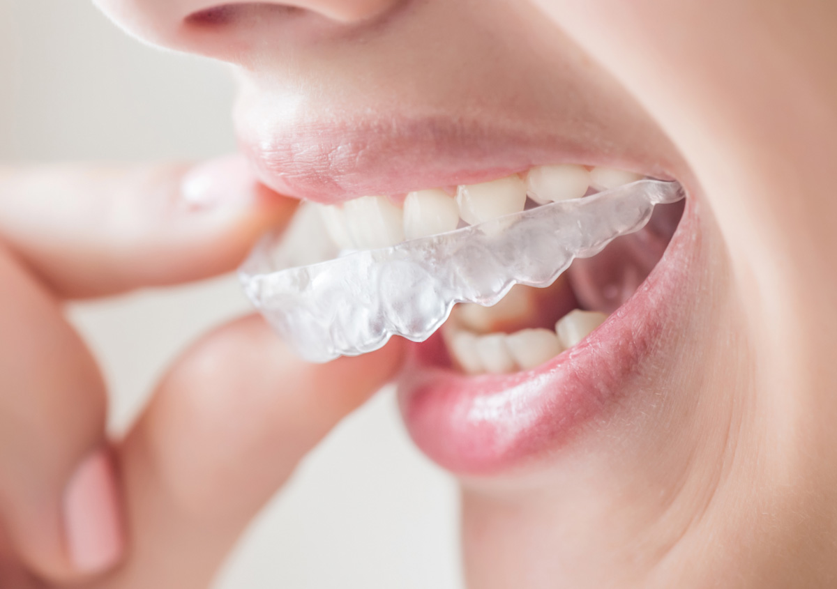 clareamento dental caseiro dra jaqueline teles