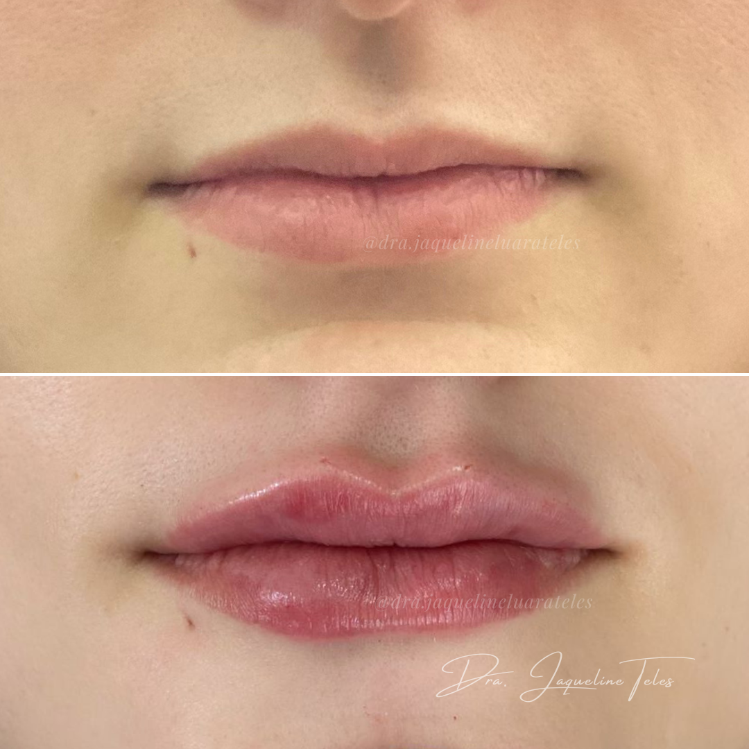 ANTES E DEPOIS PREENCHIENOT LABIAL
