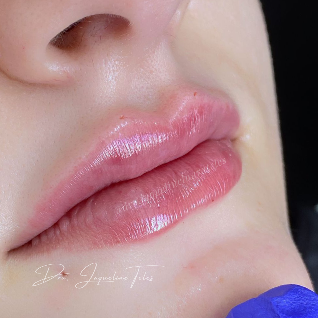 PREENCHIMENTO LABIAL (2)